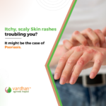 man having a itchy skin , case of psoriasis